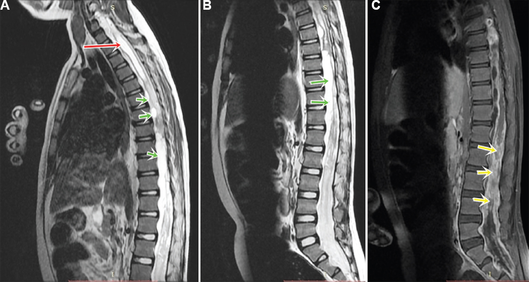 (A) Magnetic resonance imaging (MRI) cervicodorsal spine showing syrinx involving the cervical spine (red arrow) and cerebral spinal fluid loculations along the dorsal spine (green arrows). (B) MRI lumbosacral spine T2-weighted image showing cerebral spinal fluid loculations around lumbar spine (green arrows). (C) Post-contrast image showing enhancement and clumping of roots (yellow arrows).